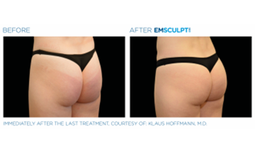 Non-Surgical Butt Lift Before & After
